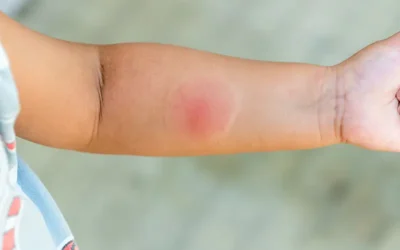 Five Common Summer Ailments – Be Ready with the ICD 10 Codes