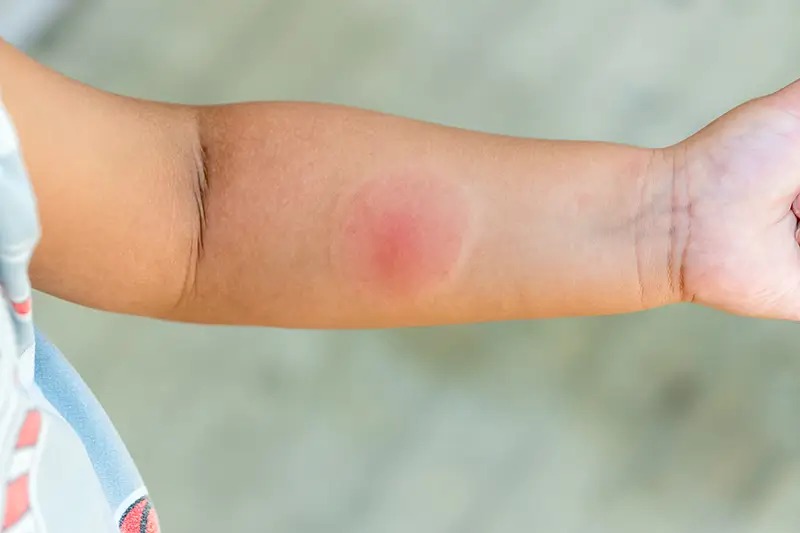 Five Common Summer Ailments Five Common Summer Ailments – Be Ready with the ICD 10 Codes