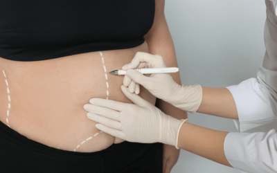 Bariatric Insurance Verification – Overcoming Challenges of Confirming Patient Eligibility for Weight Loss Surgery