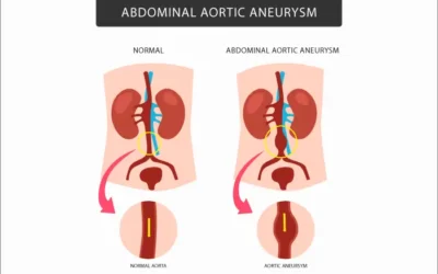 Abdominal Aortic Aneurysm (AAA) – Screening and Coding Guidelines