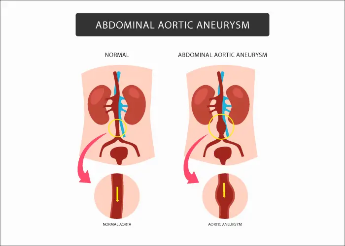 Abdominal Aortic Aneurysm (AAA) - Screening and Coding Guidelines