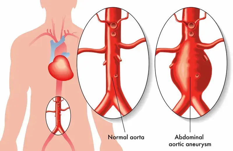 Abdominal Aortic Aneurysm