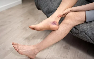 How to Code Cellulitis Using ICD-10 Medical Codes