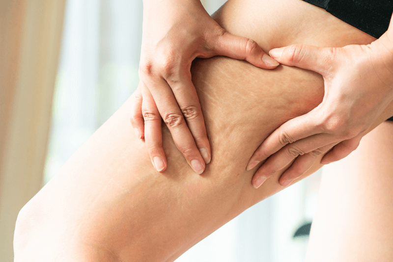 Code Cellulitis Using ICD-10 Medical Codes