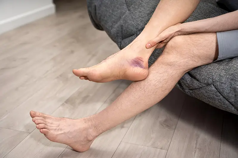 How to Code Cellulitis Using ICD-10 Medical Codes