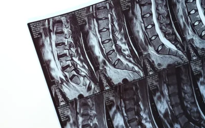 Coding and Documenting Cervical and Lumbar Radiculopathy