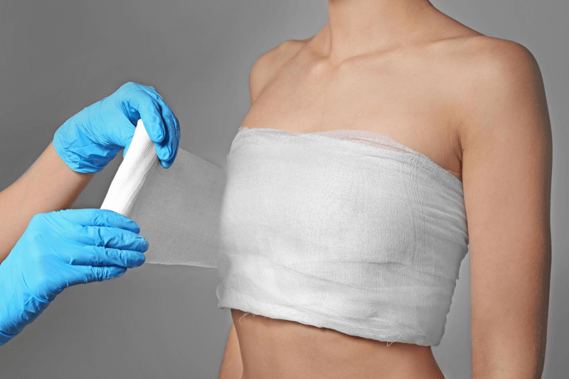 Coding for Mastectomy