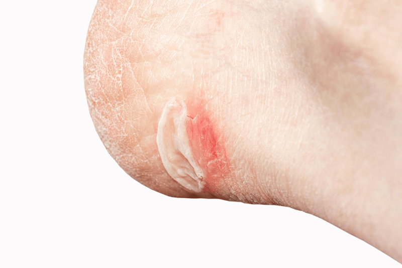 Coding Pressure Ulcers