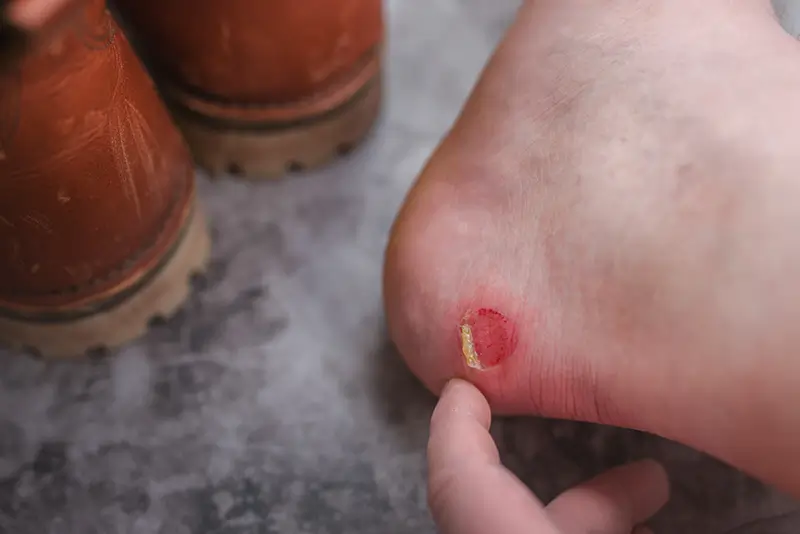 Coding Pressure Ulcers – Quality Documentation is Critical