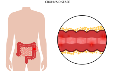 Documenting and Coding Crohn’s Disease – Key Considerations