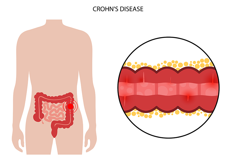 Documenting and Coding Crohn's Disease