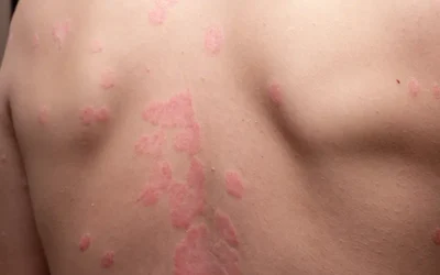 Reporting Psoriasis Diagnosis and Management