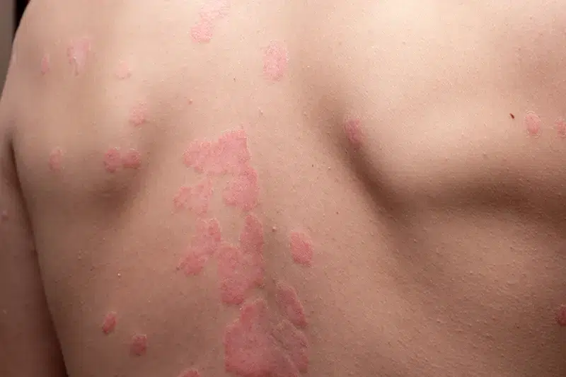 Reporting Psoriasis Diagnosis Reporting Psoriasis Diagnosis and Management