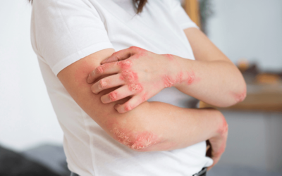 Reporting Psoriasis Diagnosis and Management