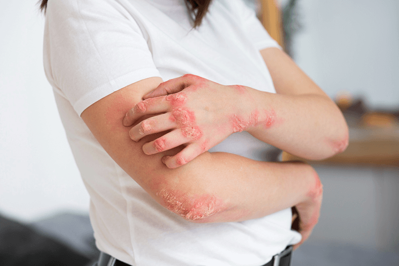 Psoriasis Diagnosis and Management