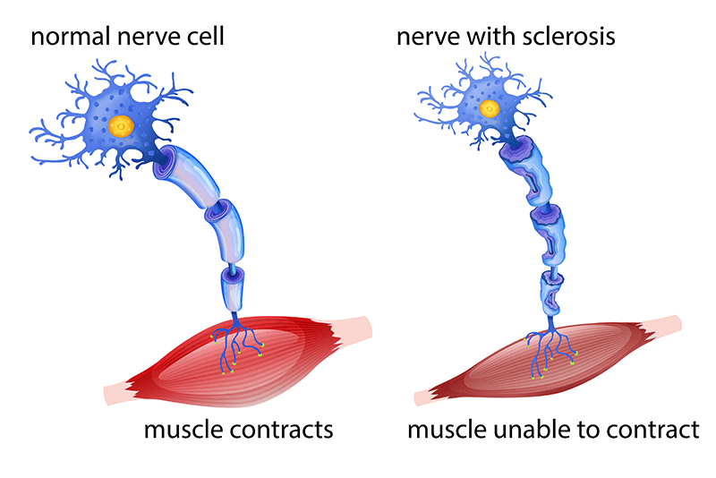 Coding Primary Lateral Sclerosis (PLS) – Quality Documentation is Vital