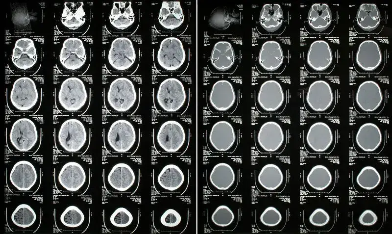 Documenting Coding Subdural Hematoma