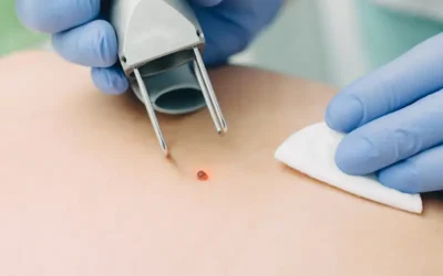 Medical Coding for Skin Biopsies – Use the Correct CPT Codes