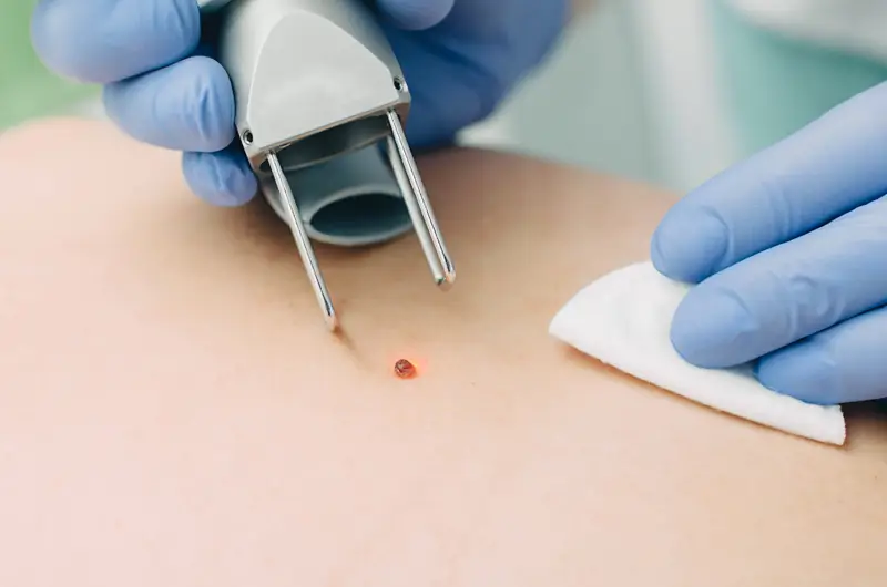 Medical Coding for Skin Biopsies – Use the Correct CPT Codes