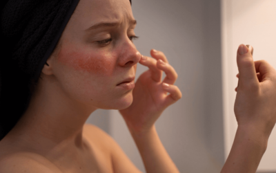 Reporting Rosacea: An Overview of Diagnosis, Treatment and Coding