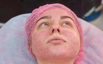 Reporting Rosacea: An Overview of Diagnosis, Treatment and Coding