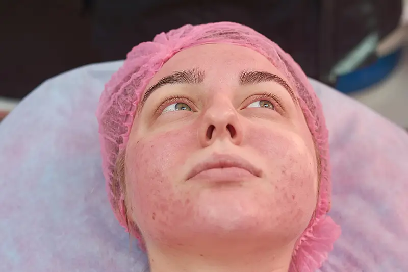 Reporting Rosacea: An Overview of Diagnosis, Treatment and Coding