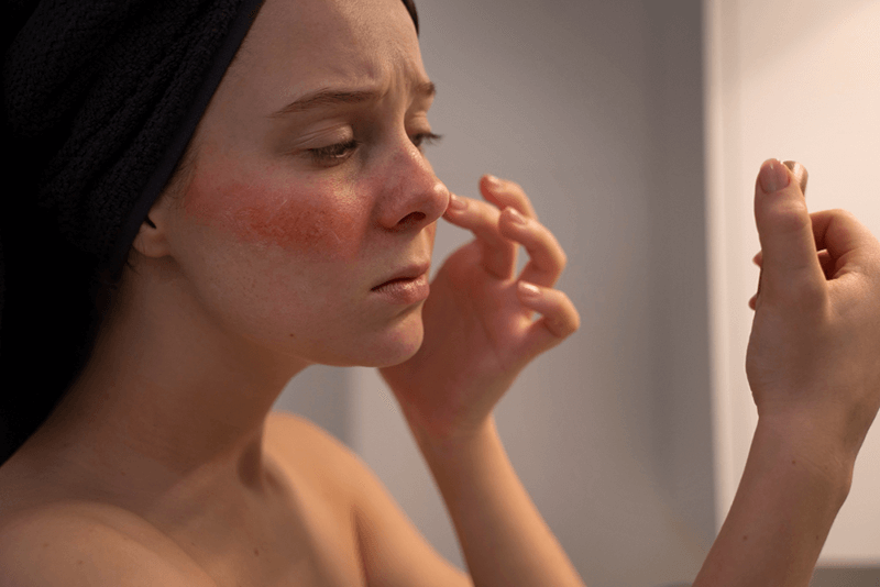 Reporting Rosacea: An Overview of Diagnosis, Treatment and Coding