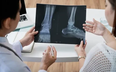 Osteomyelitis Coding in ICD-10 – Ensure Specificity