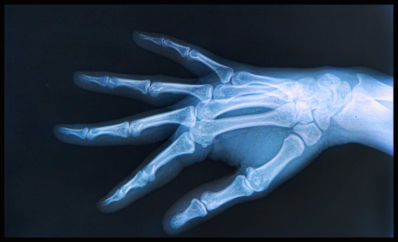 Osteomyelitis Coding in ICD 10