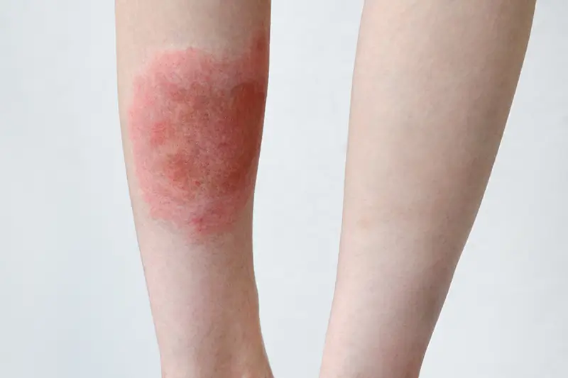 Atopic Dermatitis Symptoms and ICD-10 Codes Atopic Dermatitis - An Overview of the Symptoms and ICD-10 Codes