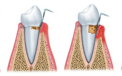 How to Code for Gingivitis Using ICD-10 Medical Codes