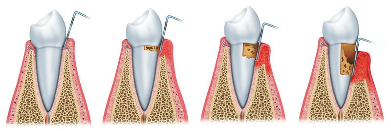 How to Code for Gingivitis Using ICD-10 Medical Codes