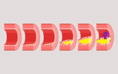 Learn the ICD-10 Codes to Document Atherosclerosis