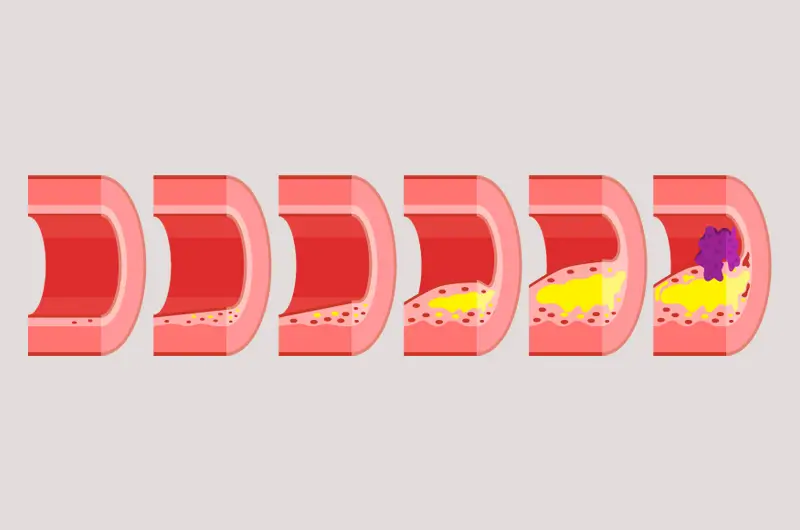 ICD-10 Codes to Document Atherosclerosis Learn the ICD-10 Codes to Document Atherosclerosis
