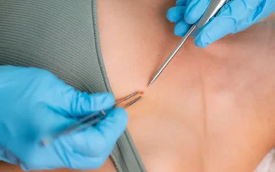 Medical Coding Steps and Guidelines for Lesion Excision