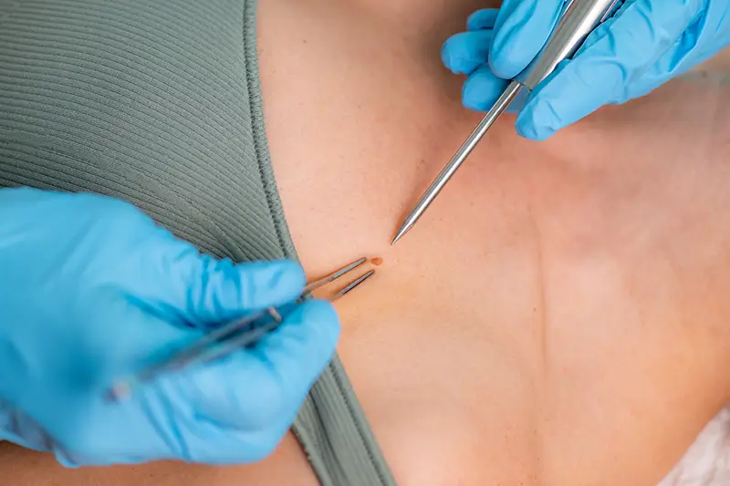 Medical Coding Steps and Guidelines for Lesion Excision