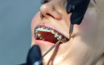 Steps involved in Billing for Orthodontic Services