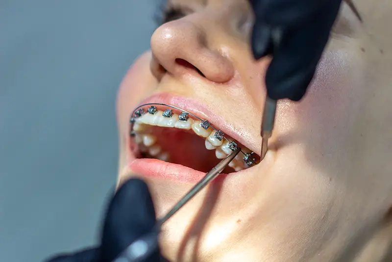 Steps involved in Billing for Orthodontic Services