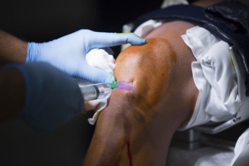 Billing and Coding Arthroscopic Knee Surgery