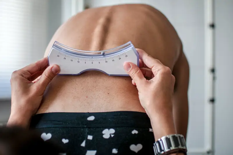 Reporting Scoliosis Reporting Scoliosis – An Overview of the Condition and Medical Codes