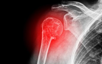 Coding Osteoporotic Fractures – What Coders Should Know