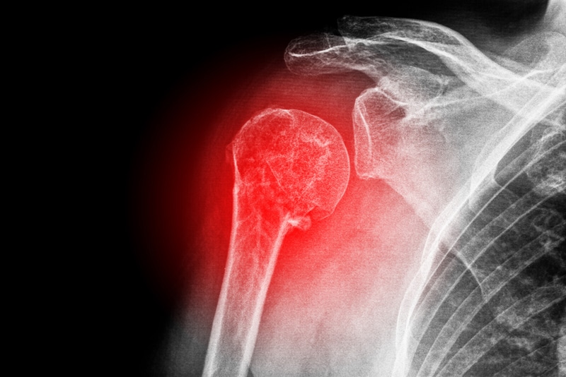 Coding Osteoporotic Fractures What Coders Should Know