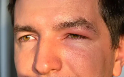 ICD-10 Codes to Report the Auto-Immune Disease Myasthenia Gravis