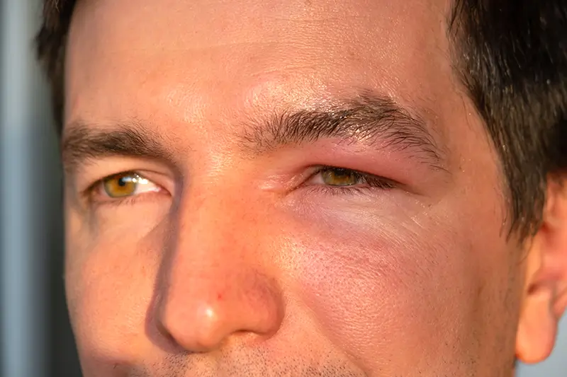 ICD-10 Codes to Report the Auto-Immune Disease Myasthenia Gravis