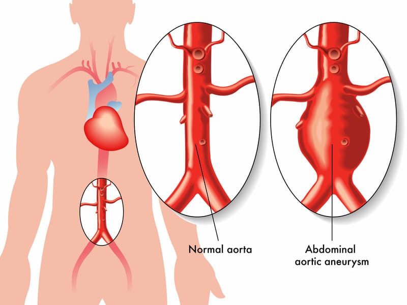 Abdominal Aortic Aneurysm Repair Report the Correct CPT Codes