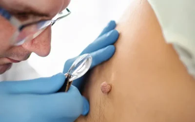 Actinic Keratosis – Coding, Billing and Clinical Information