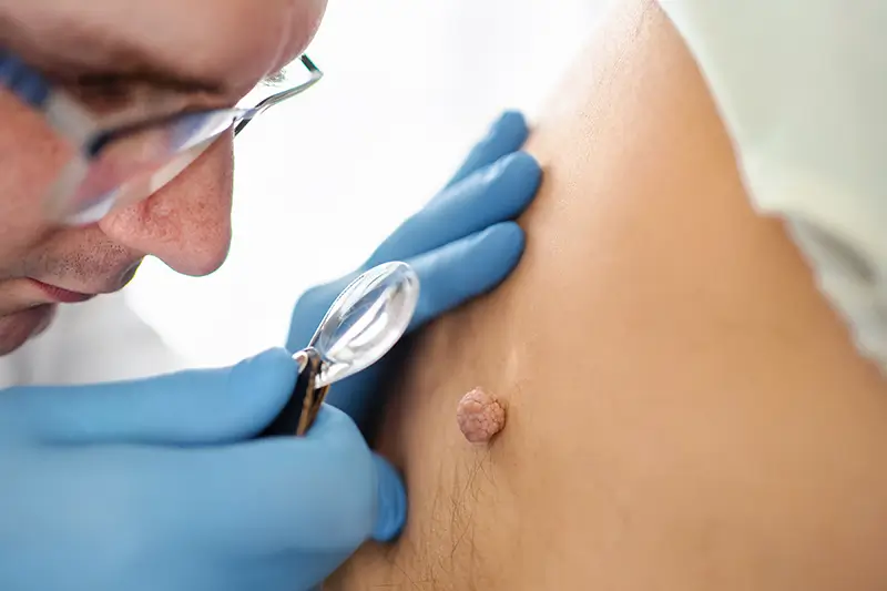 Actinic Keratosis – Coding, Billing and Clinical Information