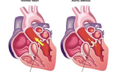 CMS Revises Rules for Transcatheter Aortic Valve Replacement (TAVR)