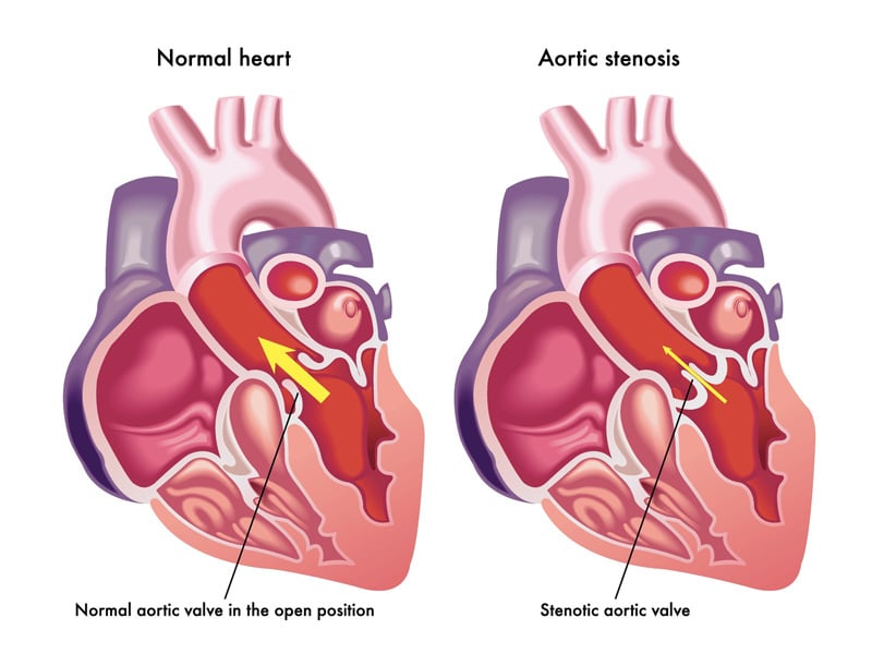 CMS Updates Rules for TAVR: What You Need to Know