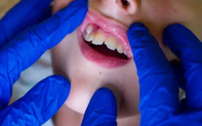 ICD-10 Codes for Coding a Common Dental Condition – Hyperdontia